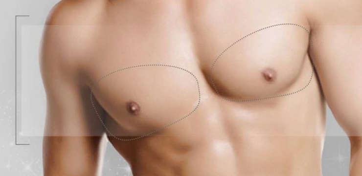 Gynecomastia in Plastic Surgery Tijuana is a disorder in men characterized by excess glandular tissue in the breast area, of the chest.