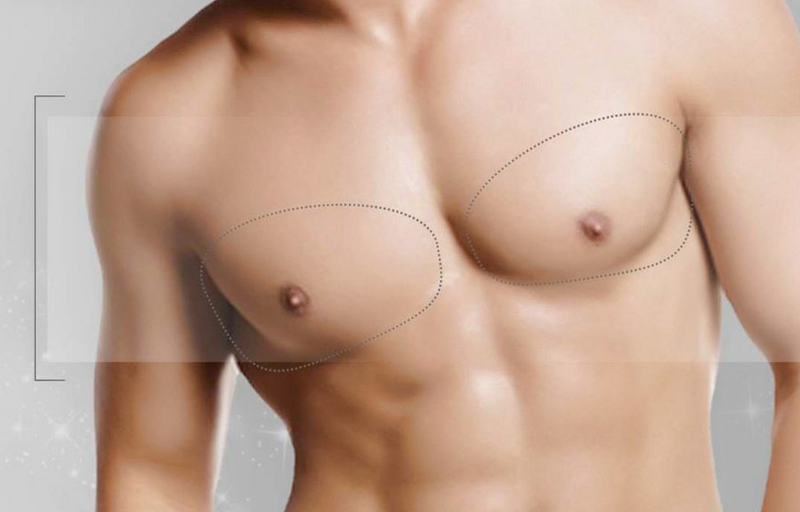 Gynecomastia