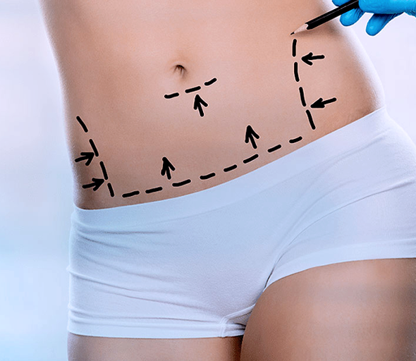 Liposuction or liposculpture in Plastic Surgery Tijuana is a safe and effective way, to help remove stubborn body fat from various parts of the body.