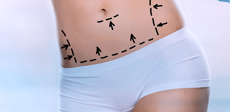 Liposuction or liposculpture in Plastic Surgery Tijuana is a safe and effective way, to help remove stubborn body fat from various parts of the body.