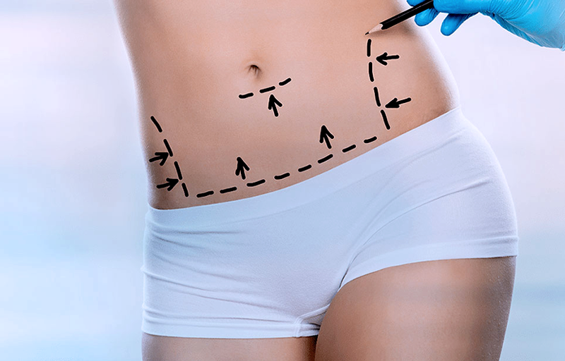 Liposuction