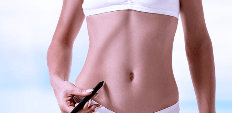 Tummy Tuck, or Abdominoplasty in Plastic Surgery Tijuana is performed to correct an excess amount of skin/subcutaneous tissue in the abdominal area.